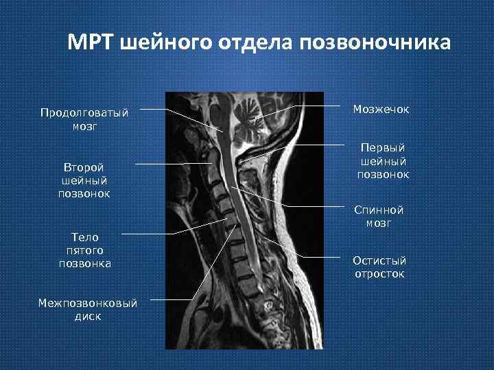 МРТ шейного отдела позвоночника Продолговатый мозг Второй шейный позвонок Мозжечок Первый шейный позвонок Спинной