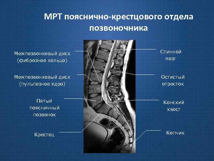 МРТ пояснично-крестцового отдела позвоночника Межпозвонковый диск (фиброзное кольцо) Спинной мозг Межпозвонковый диск (пульпозное ядро)