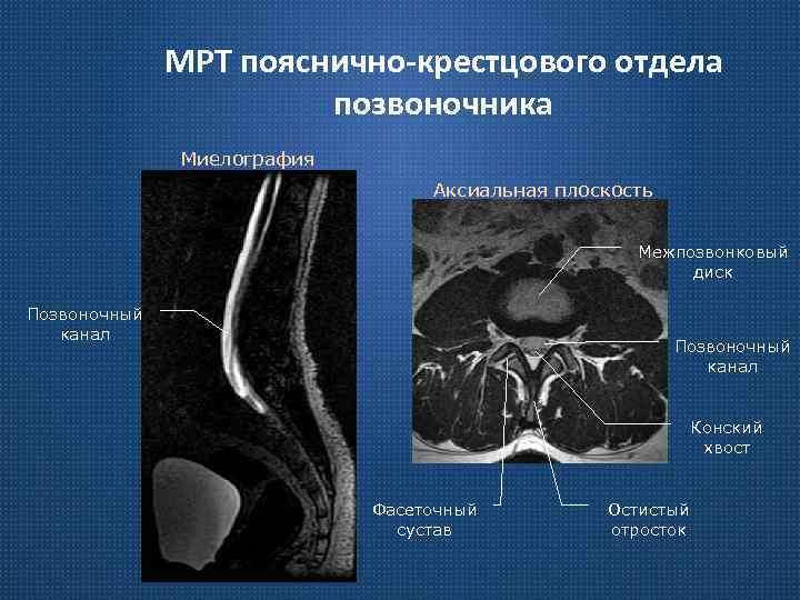 МРТ пояснично-крестцового отдела позвоночника Миелография Аксиальная плоскость Межпозвонковый диск Позвоночный канал Конский хвост Фасеточный