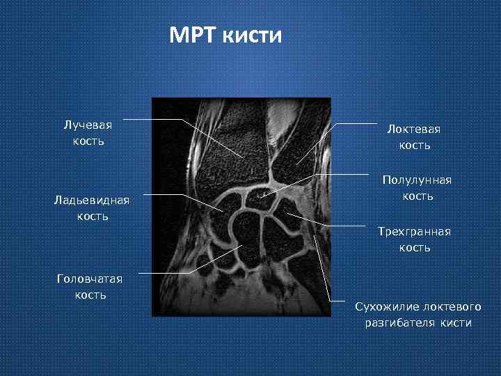 МРТ кисти Лучевая кость Ладьевидная кость Локтевая кость Полулунная кость Трехгранная кость Головчатая кость