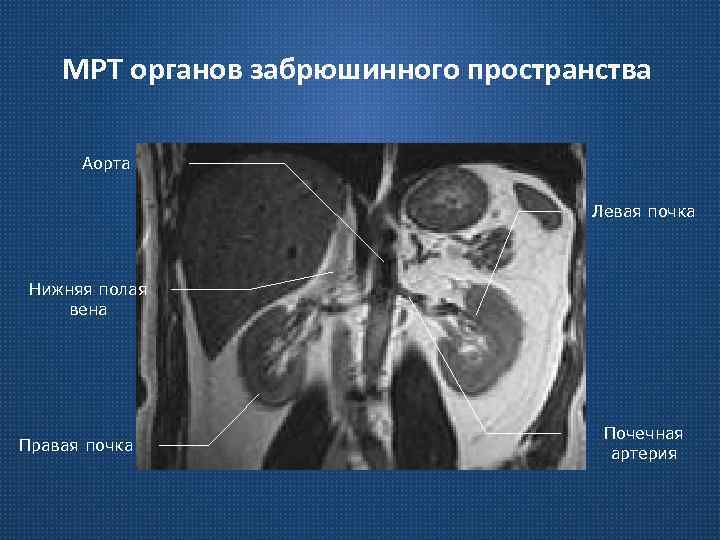 МРТ органов забрюшинного пространства Аорта Левая почка Нижняя полая вена Правая почка Почечная артерия