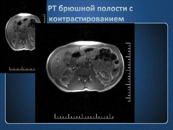 МРТ брюшной полости с контрастированием 