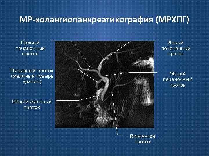 МР-холангиопанкреатикография (МРХПГ) Правый печеночный проток Левый печеночный проток Пузырный проток (желчный пузырь удален) Общий