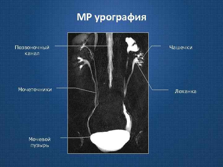 МР урография Позвоночный канал Мочеточники Мочевой пузырь Чашечки Лоханка 