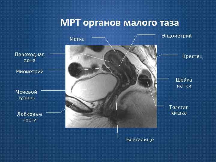 МРТ органов малого таза Эндометрий Матка Переходная зона Крестец Миометрий Шейка матки Мочевой пузырь