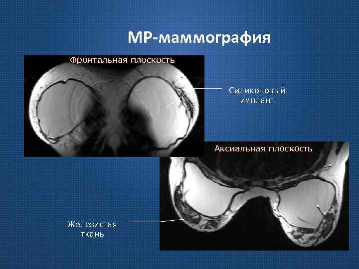 МР-маммография Фронтальная плоскость Силиконовый имплант Аксиальная плоскость Железистая ткань 