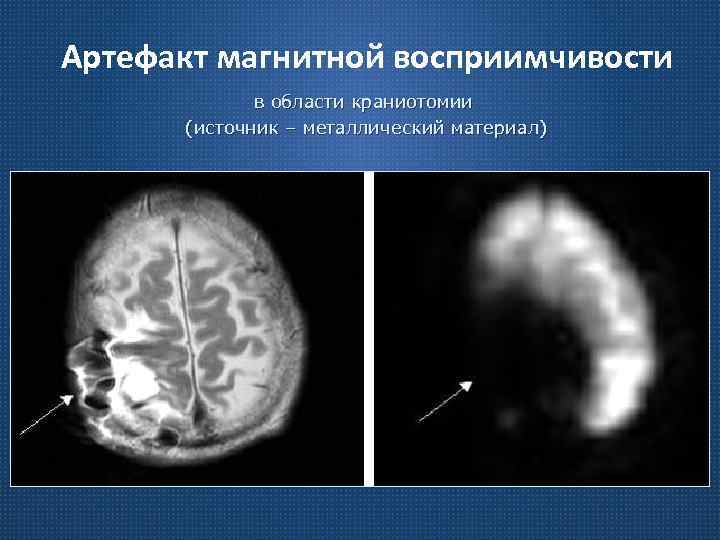 Артефакт магнитной восприимчивости в области краниотомии (источник – металлический материал) 