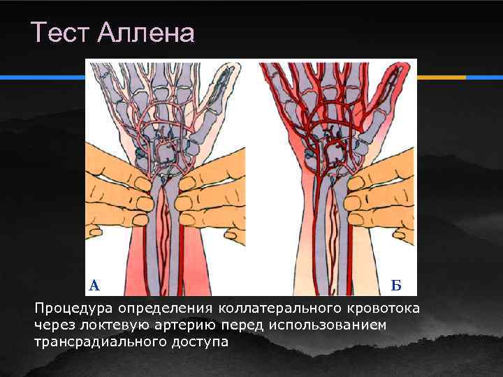 Интермедиарная артерия на рисунке