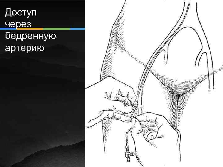 Доступ через бедренную артерию 