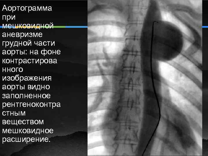 Аневризма грудной аорты фото