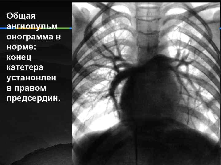 Общая ангиопульм онограмма в норме: конец катетера установлен в правом предсердии. 