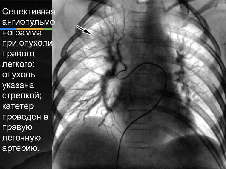 Селективная ангиопульмо нограмма при опухоли правого легкого: опухоль указана стрелкой; катетер проведен в правую