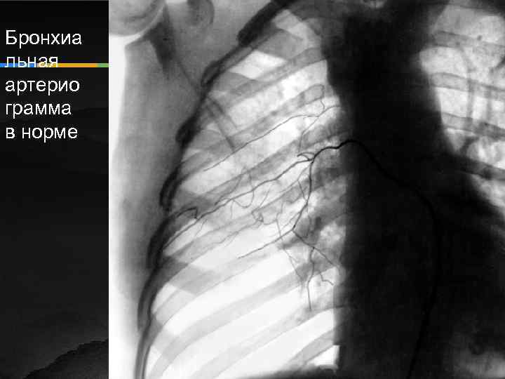 Бронхиа льная артерио грамма в норме 