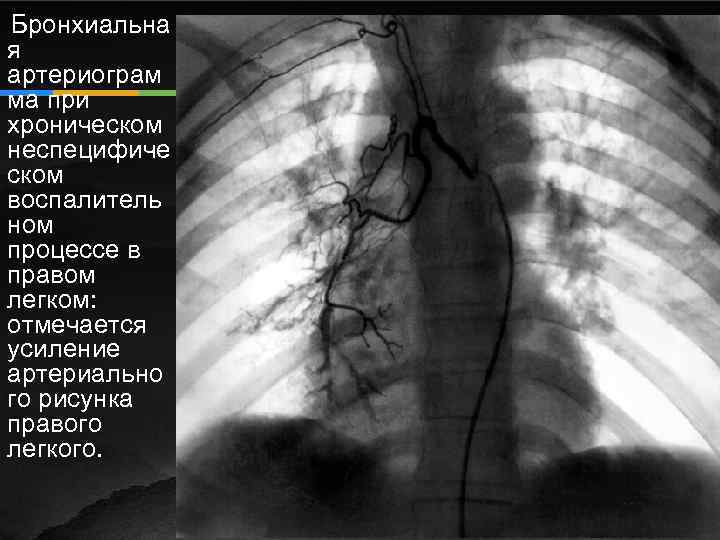 Усилен сосудистый рисунок легких