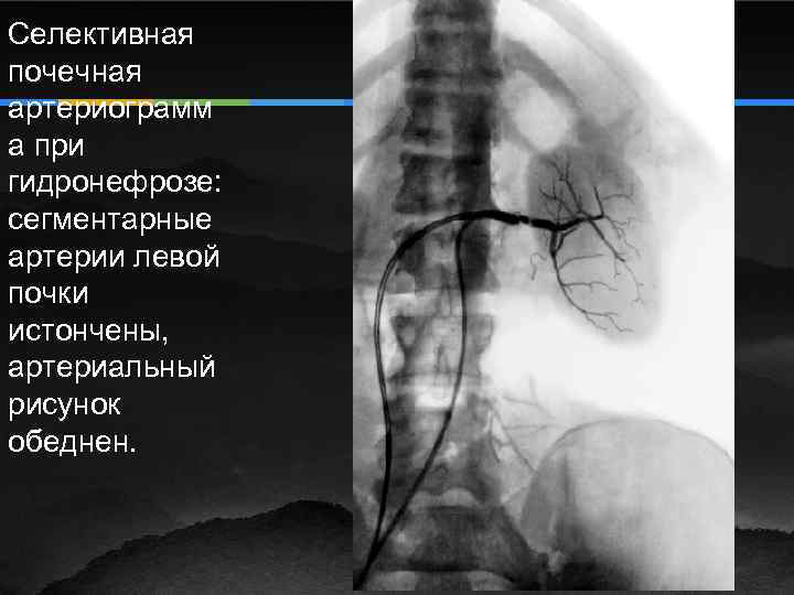 Селективная почечная артериограмм а при гидронефрозе: сегментарные артерии левой почки истончены, артериальный рисунок обеднен.