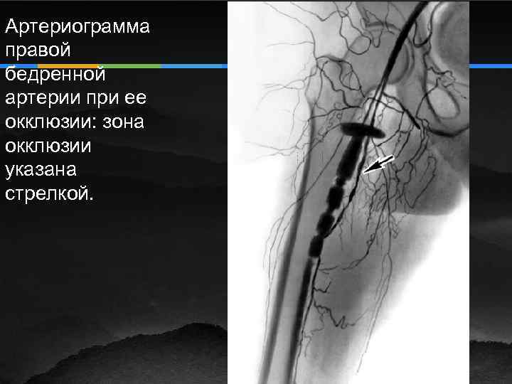Артериограмма правой бедренной артерии при ее окклюзии: зона окклюзии указана стрелкой. 