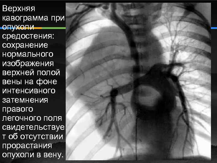 Рентген сердца. Верхняя полая Вена рентген. Ангиография средостения. Ангиограмма легочной артерии. Тень верхней полой вены рентген.