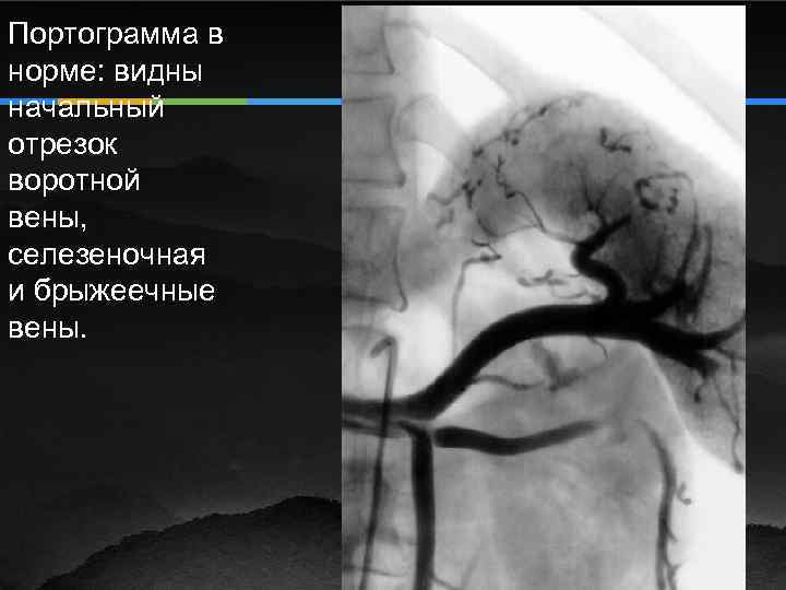 Портограмма в норме: видны начальный отрезок воротной вены, селезеночная и брыжеечные вены. 