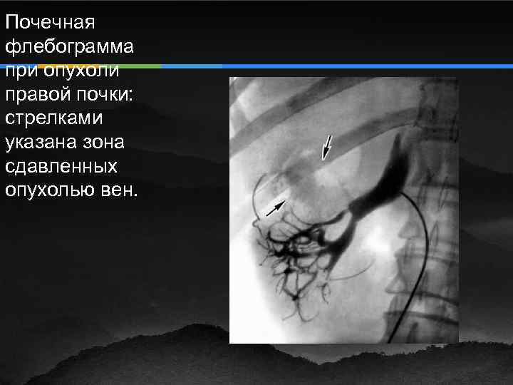 Почечная флебограмма при опухоли правой почки: стрелками указана зона сдавленных опухолью вен. 