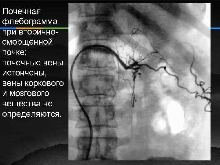 Почечная флебограмма при вторичносморщенной почке: почечные вены истончены, вены коркового и мозгового вещества не