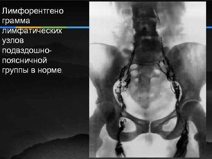 Лимфорентгено грамма лимфатических узлов подвздошнопоясничной группы в норме. 