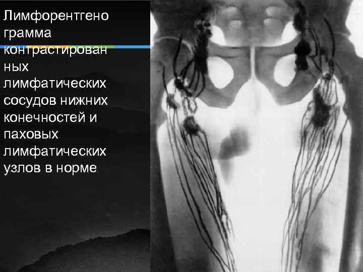 Лимфорентгено грамма контрастирован ных лимфатических сосудов нижних конечностей и паховых лимфатических узлов в норме.