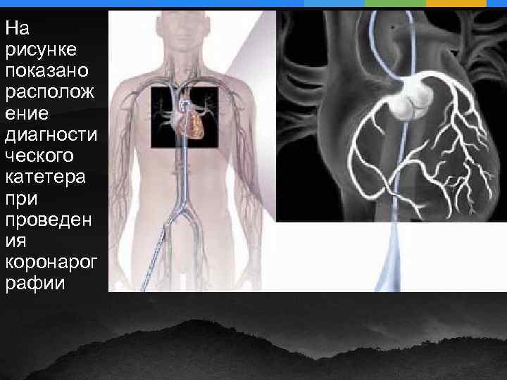 На рисунке показано располож ение диагности ческого катетера при проведен ия коронарог рафии 