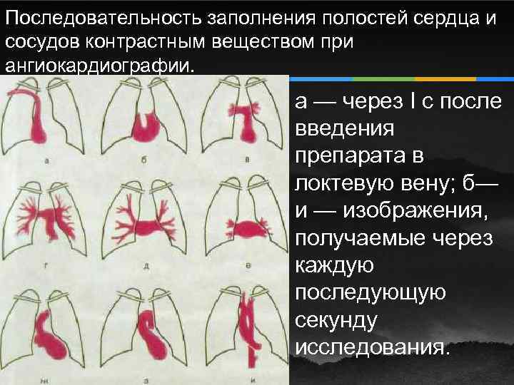 Последовательность заполнения полостей сердца и сосудов контрастным веществом при ангиокардиографии. а — через I