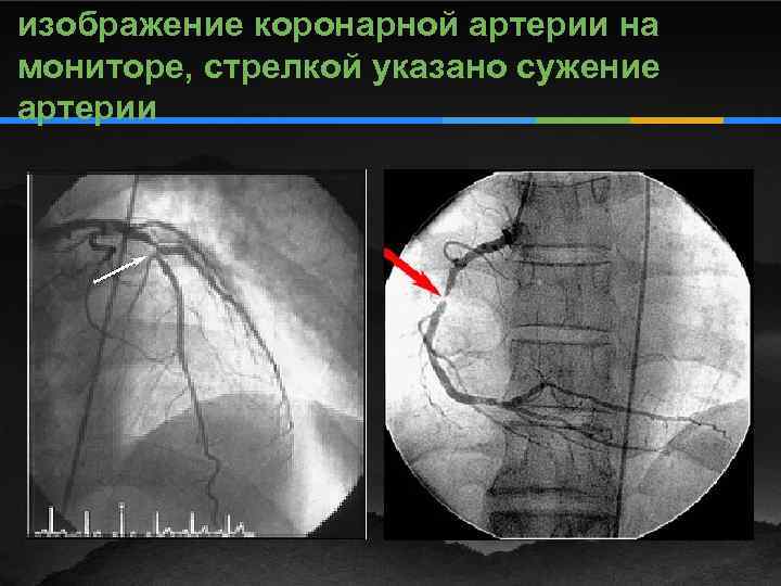 изображение коронарной артерии на мониторе, стрелкой указано сужение артерии 