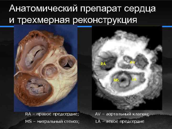 Анатомический препарат сердца и трехмерная реконструкция RA – правое предсердие; AV – аортальный клапан;