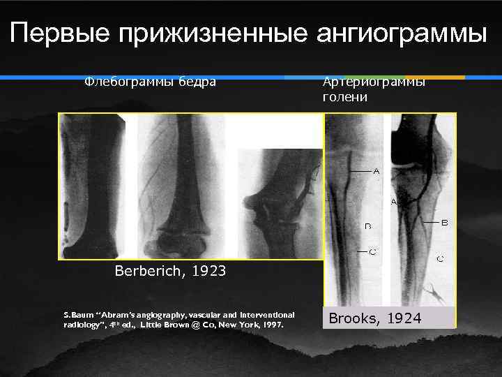 Первые прижизненные ангиограммы Флебограммы бедра Артериограммы голени Berberich, 1923 S. Baum “Abram’s angiography, vascular