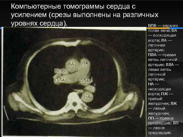 Компьютерные томограммы сердца с усилением (срезы выполнены на различных уровнях сердца). ВПВ — верхняя