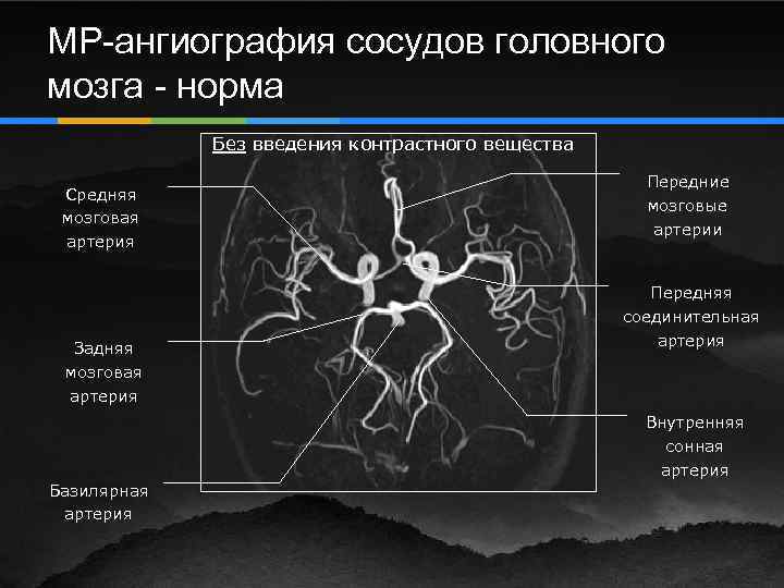 Сегменты внутренней сонной артерии схема мрт