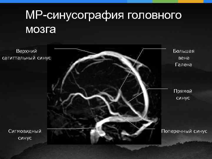 Вене галена. Венозные синусы мрт анатомия. Вена Галена анатомия кт. Тромбоз сигмовидного синуса мрт.