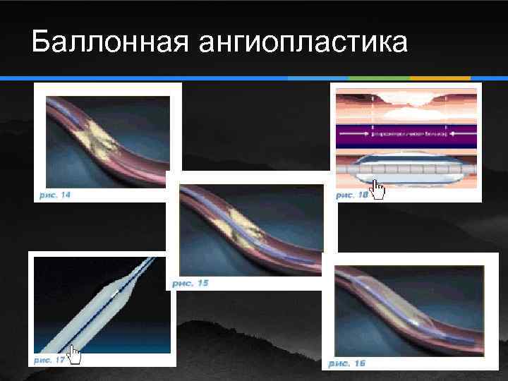 Баллонная ангиопластика 