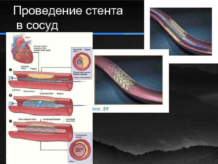 Проведение стента в сосуд 