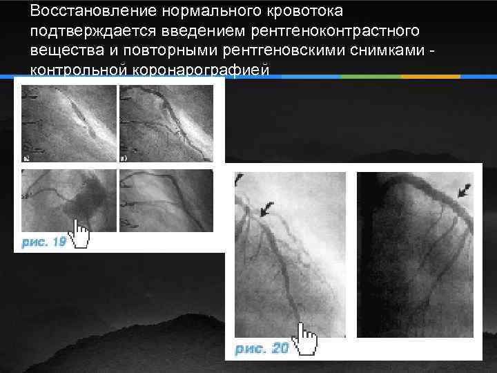 Восстановление нормального кровотока подтверждается введением рентгеноконтрастного вещества и повторными рентгеновскими снимками - контрольной коронарографией