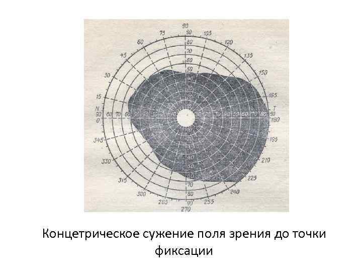 Концетрическое сужение поля зрения до точки фиксации 
