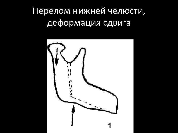 Перелом нижней челюсти, деформация сдвига 