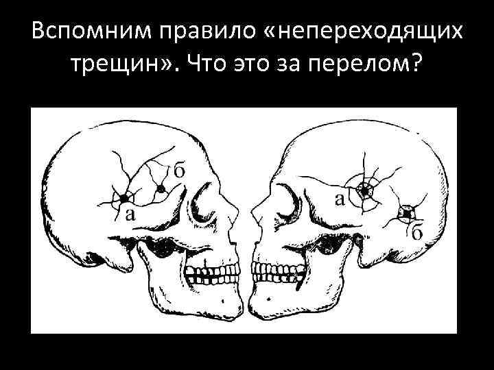 Вспомним правило «непереходящих трещин» . Что это за перелом? 