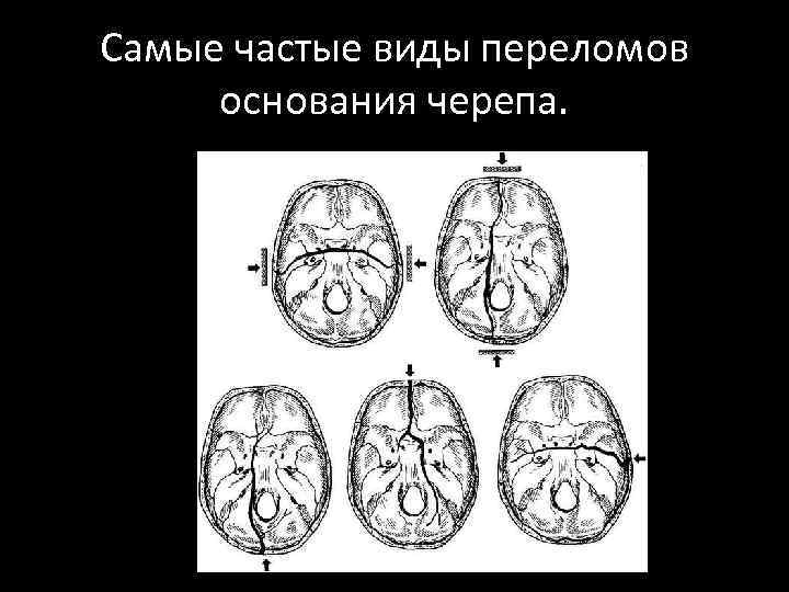 Самые частые виды переломов основания черепа. 