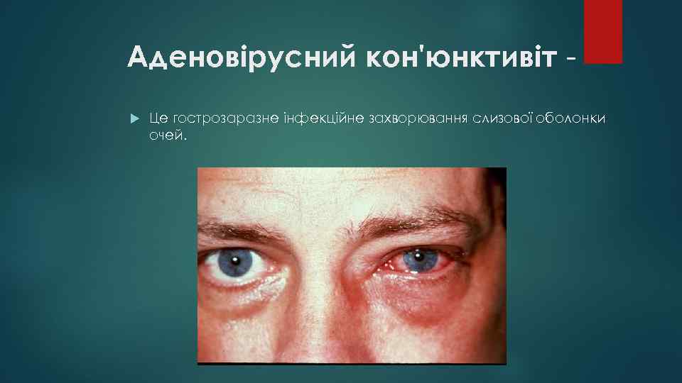 Аденовірусний кон'юнктивіт - Це гострозаразне інфекційне захворювання слизової оболонки очей. 