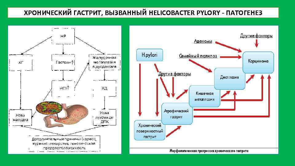 ХРОНИЧЕСКИЙ ГАСТРИТ, ВЫЗВАННЫЙ HELICOBACTER PYLORY - ПАТОГЕНЕЗ 