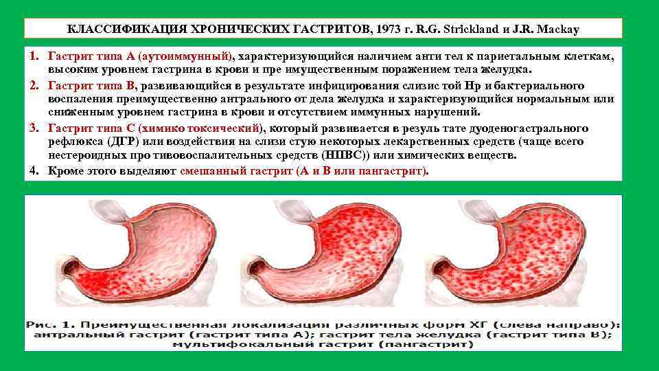 Как выглядит гастрит фото