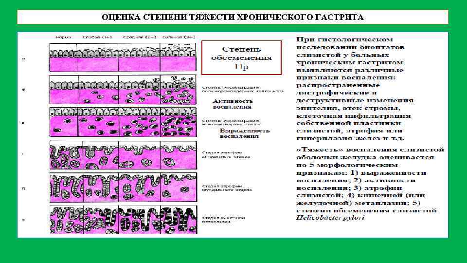 ОЦЕНКА СТЕПЕНИ ТЯЖЕСТИ ХРОНИЧЕСКОГО ГАСТРИТА 