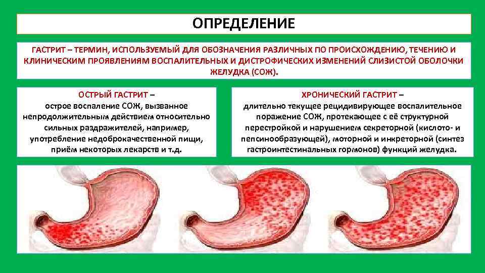 ОПРЕДЕЛЕНИЕ ГАСТРИТ – ТЕРМИН, ИСПОЛЬЗУЕМЫЙ ДЛЯ ОБОЗНАЧЕНИЯ РАЗЛИЧНЫХ ПО ПРОИСХОЖДЕНИЮ, ТЕЧЕНИЮ И КЛИНИЧЕСКИМ ПРОЯВЛЕНИЯМ