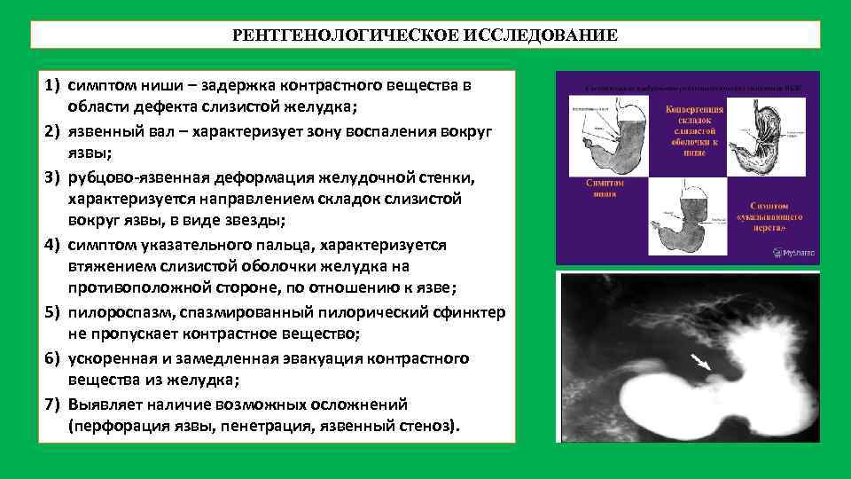 РЕНТГЕНОЛОГИЧЕСКОЕ ИССЛЕДОВАНИЕ 1) симптом ниши – задержка контрастного вещества в области дефекта слизистой желудка;