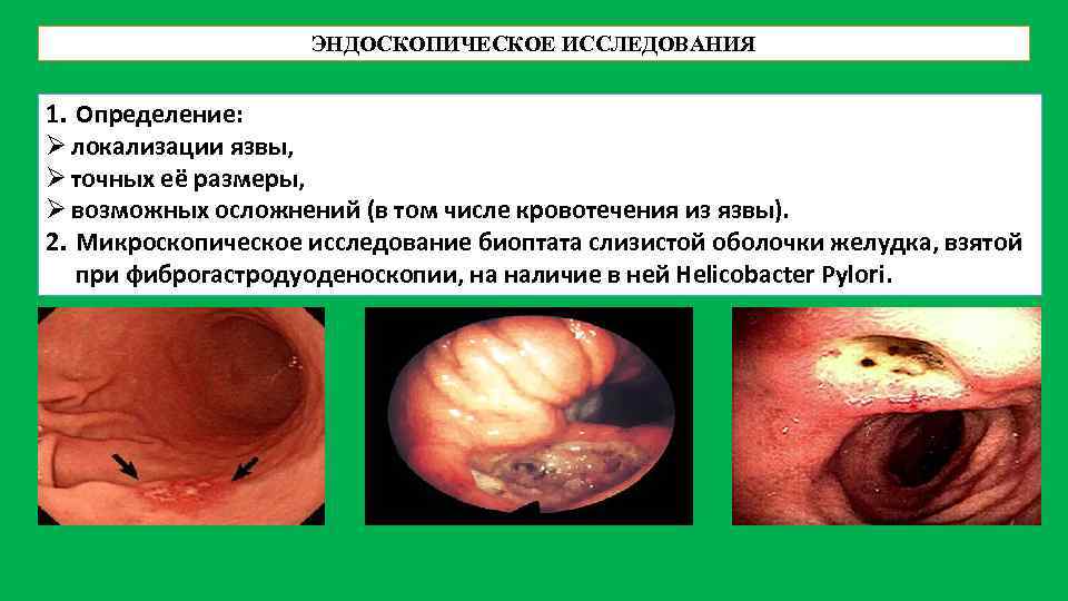 ЭНДОСКОПИЧЕСКОЕ ИССЛЕДОВАНИЯ 1. Определение: Ø локализации язвы, Ø точных её размеры, Ø возможных осложнений