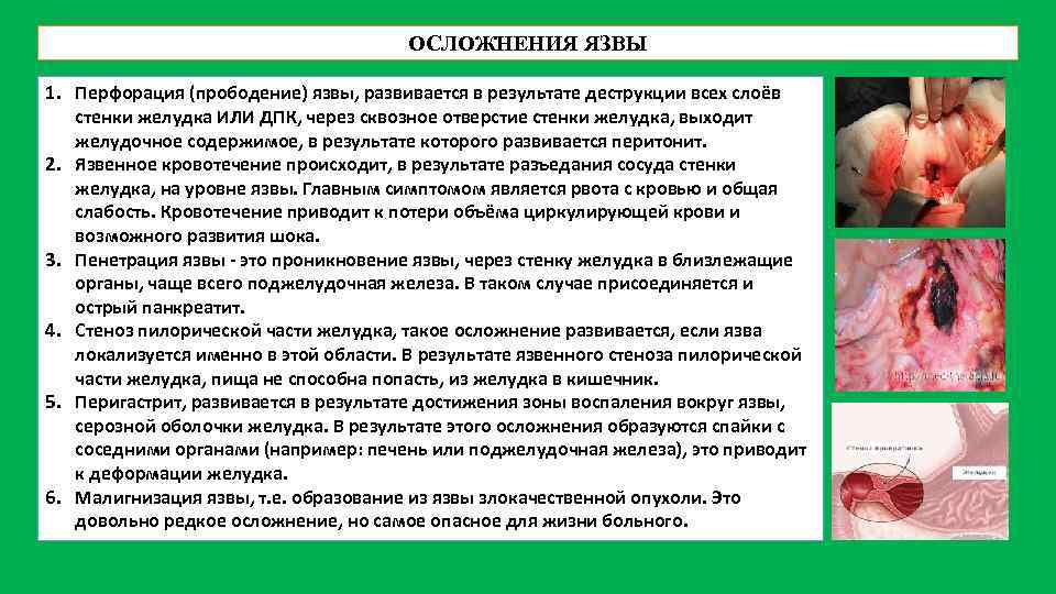 ОСЛОЖНЕНИЯ ЯЗВЫ 1. Перфорация (прободение) язвы, развивается в результате деструкции всех слоёв стенки желудка