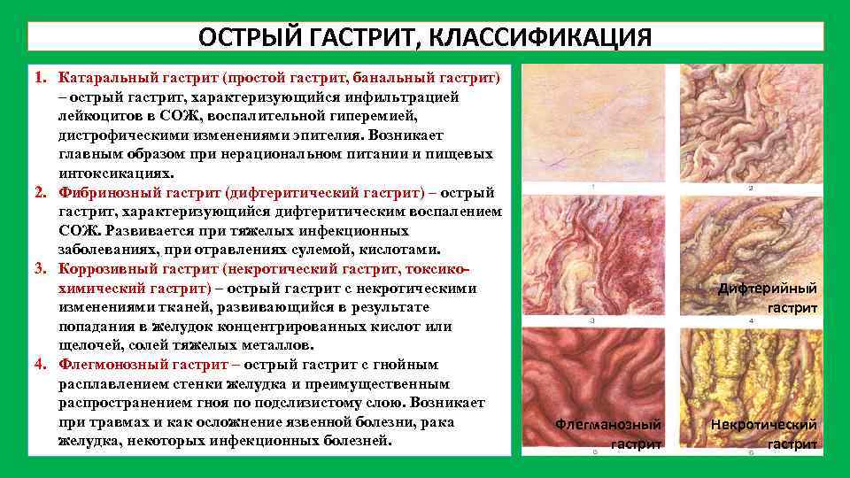 ОСТРЫЙ ГАСТРИТ, КЛАССИФИКАЦИЯ 1. Катаральный гастрит (простой гастрит, банальный гастрит) – острый гастрит, характеризующийся